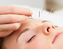 Acupuncture